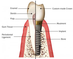 implant_anatomy1