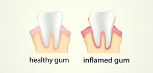 Diagram of showing gums that need periodontal care in Englewood, OH