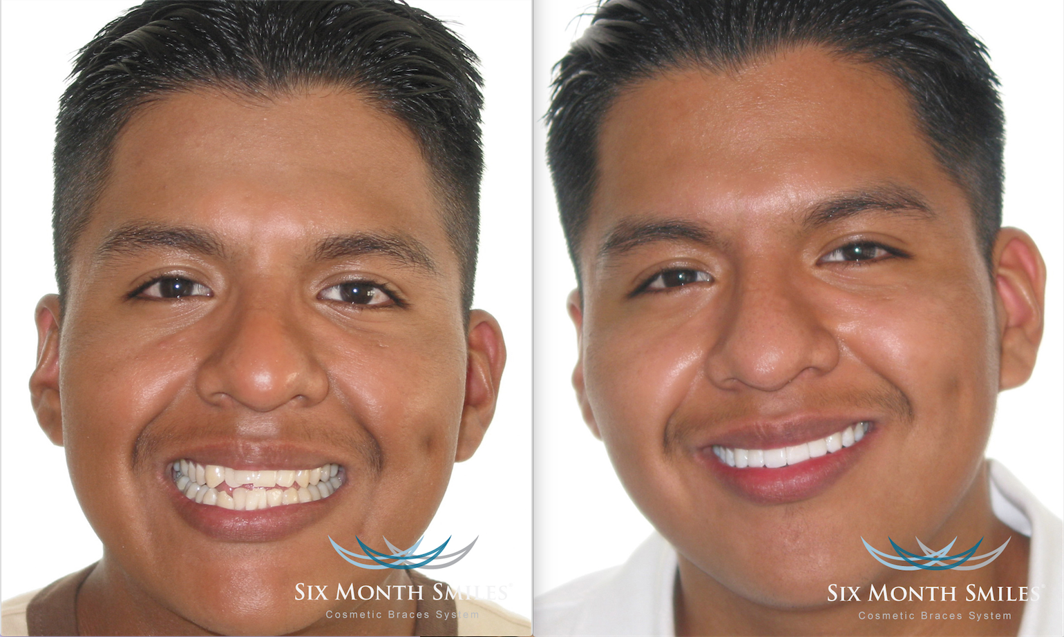6 month smiles discount